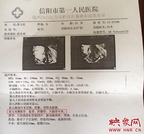 胎儿医院四维彩超显示一切正常 出生后肢体残缺