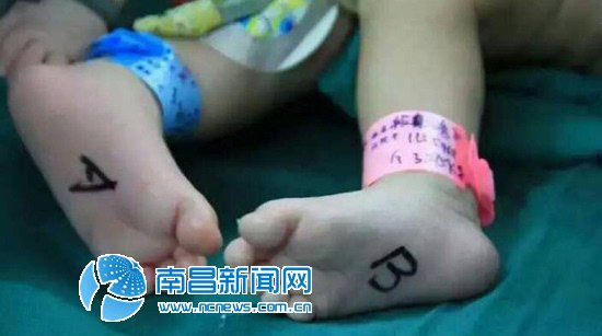 江西九江连体婴儿成功“分离”