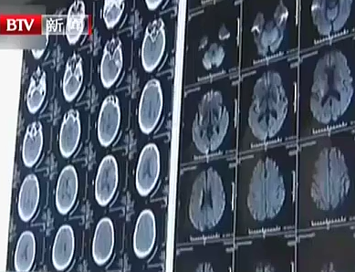 世界卒中日：卒中发病呈年轻化趋势